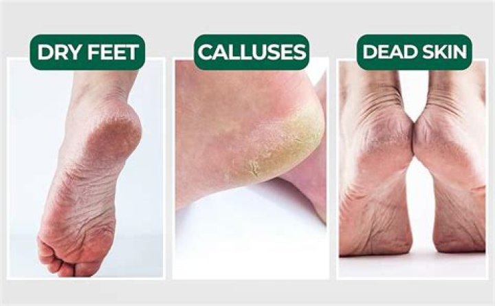 Are calluses dead skin?