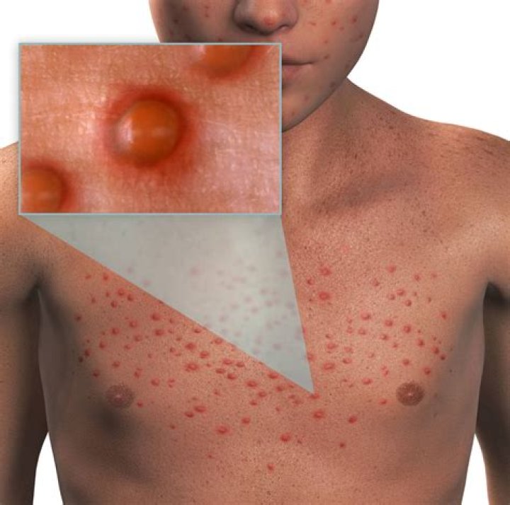 Are contagious chicken pox?