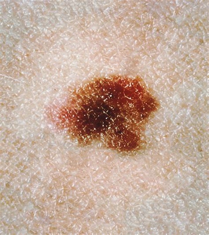 Are dysplastic nevi dangerous?