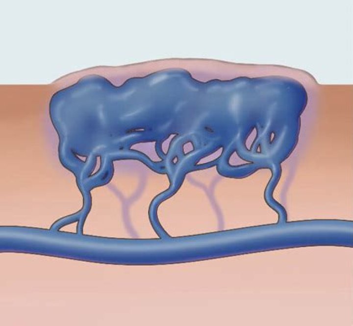 Are venous malformations dangerous?