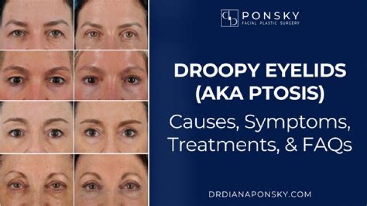 At what age do eyelids droop?