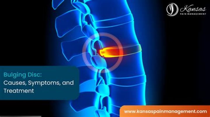 Can a bulging disc cause abdominal pain?