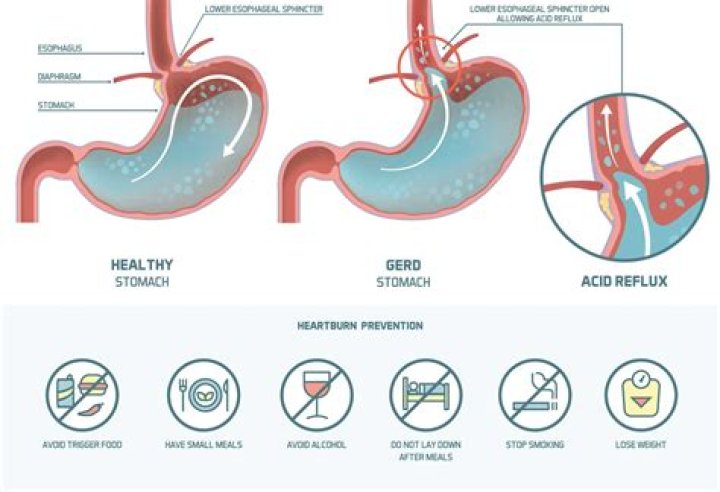 Can acid reflux cause suffocation?
