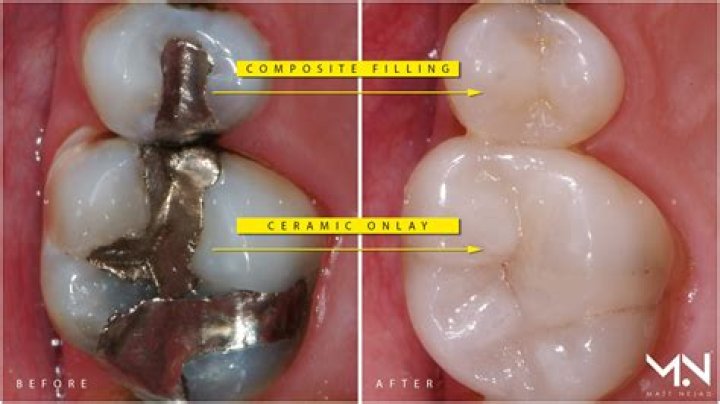 Can amalgam fillings be removed?