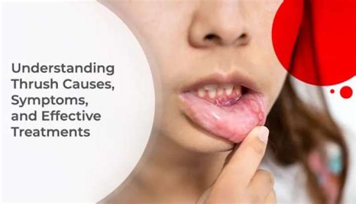 Can bio strath cause thrush?