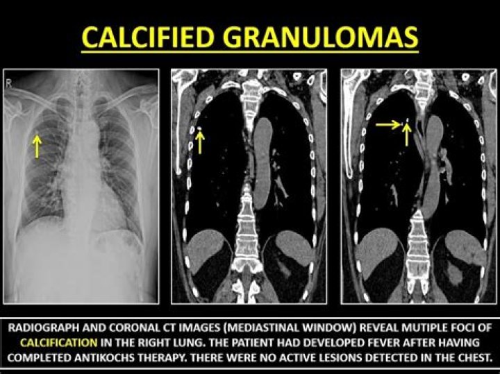 Can calcified granulomas become cancerous?