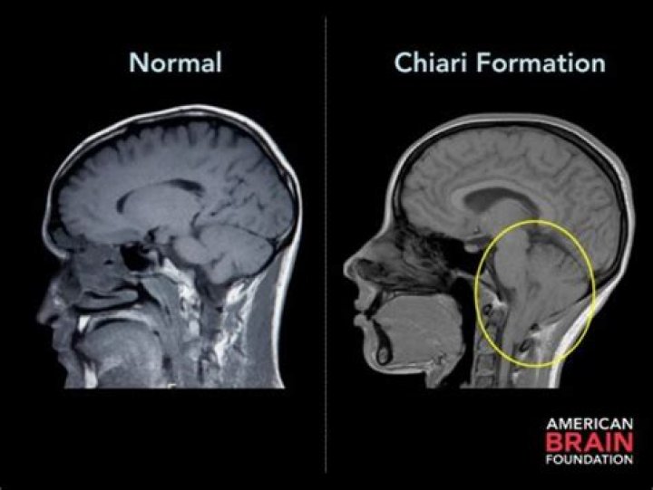Can chiari malformation kill you?