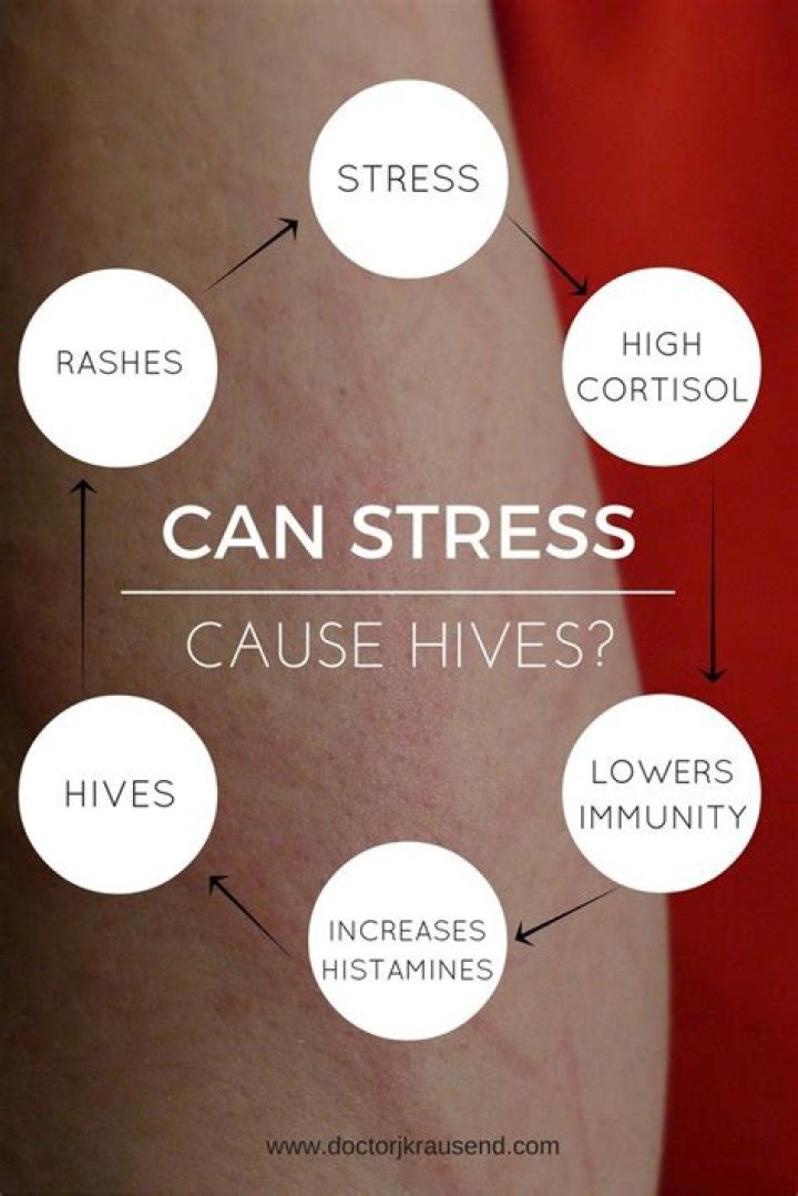 Can hives be caused by stress?
