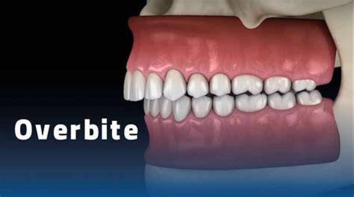 Can jaw surgery fix overbite?