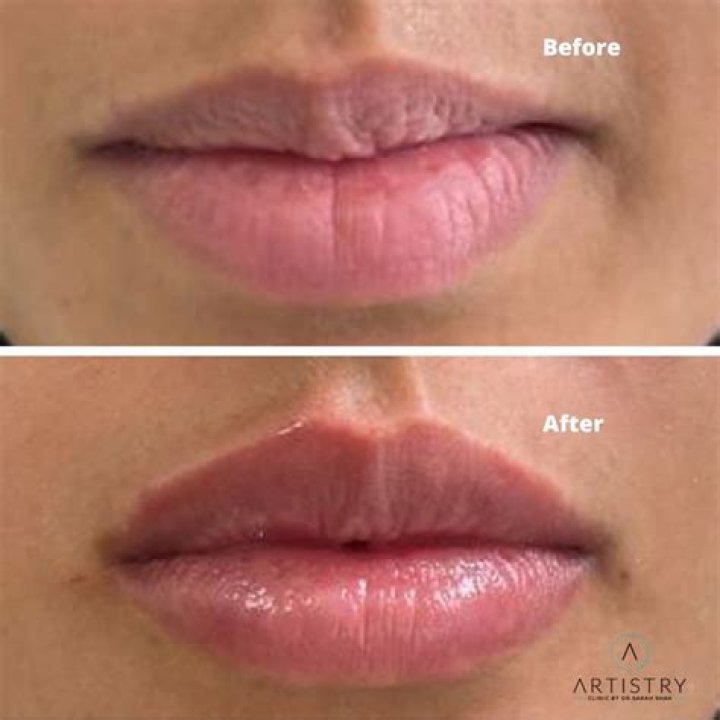 Can lip fillers look good?