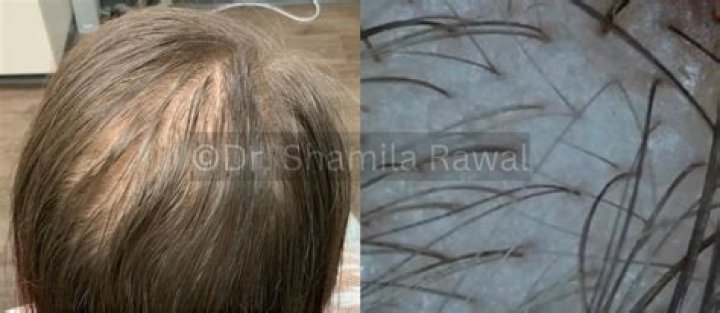 Can propylene glycol cause hair loss?