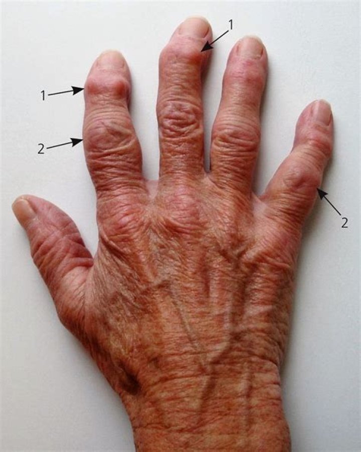 Can rheumatoid arthritis turn into osteoarthritis?