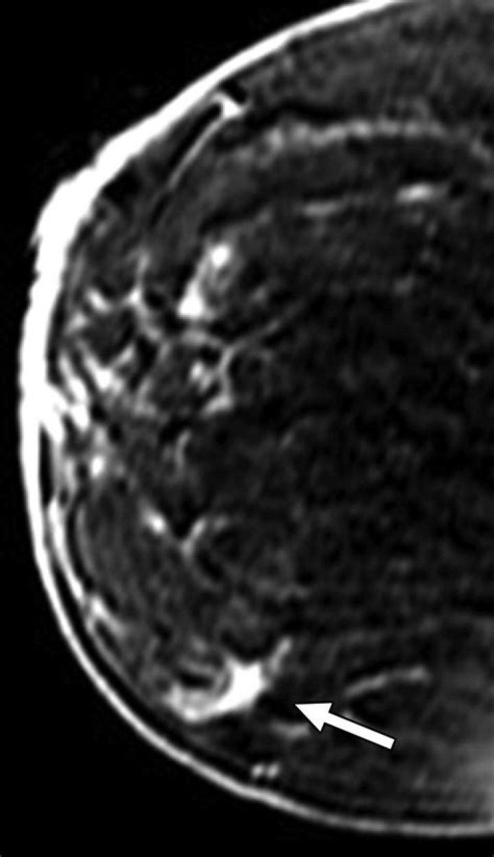 Can stromal fibrosis be misdiagnosed?