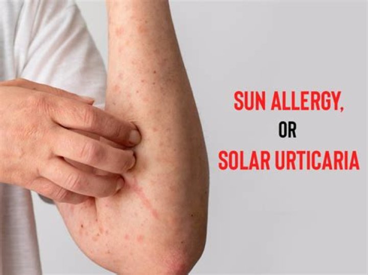 Can sun allergy go away?