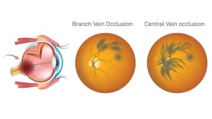 Can tubal occlusion be cured?