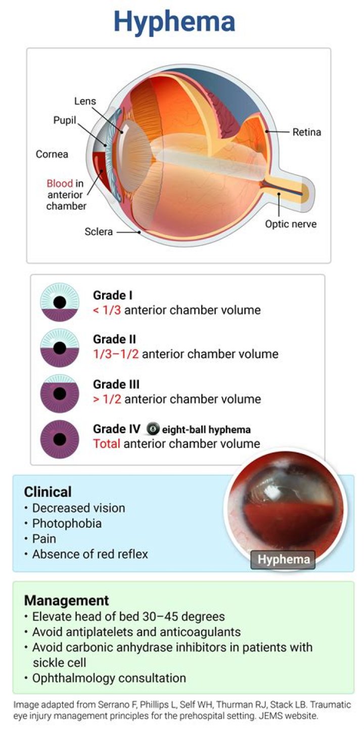 Can you fly with hyphema?