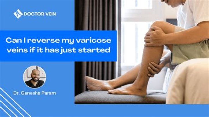 Can you reverse varicose veins?