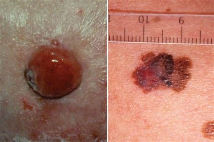 Can you scratch off nodular melanoma?