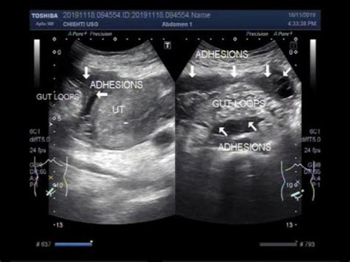 Can you see adhesions on an ultrasound?