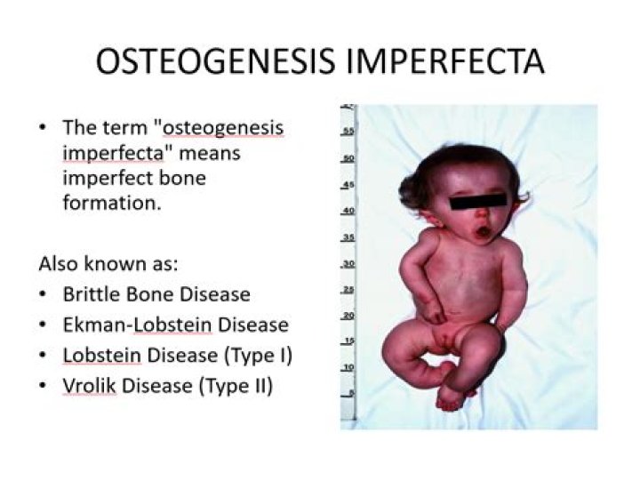 Can you walk with osteogenesis imperfecta?