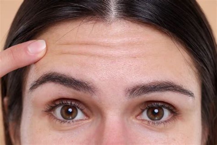 Can you wrinkle forehead with bell's palsy?