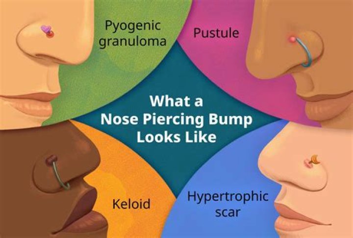Could i be allergic to my nose piercing?