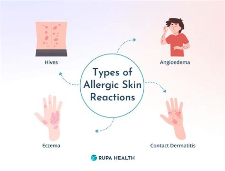 Could i be allergic to sodium chloride?