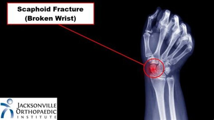 Could i have a hairline fracture in my wrist?