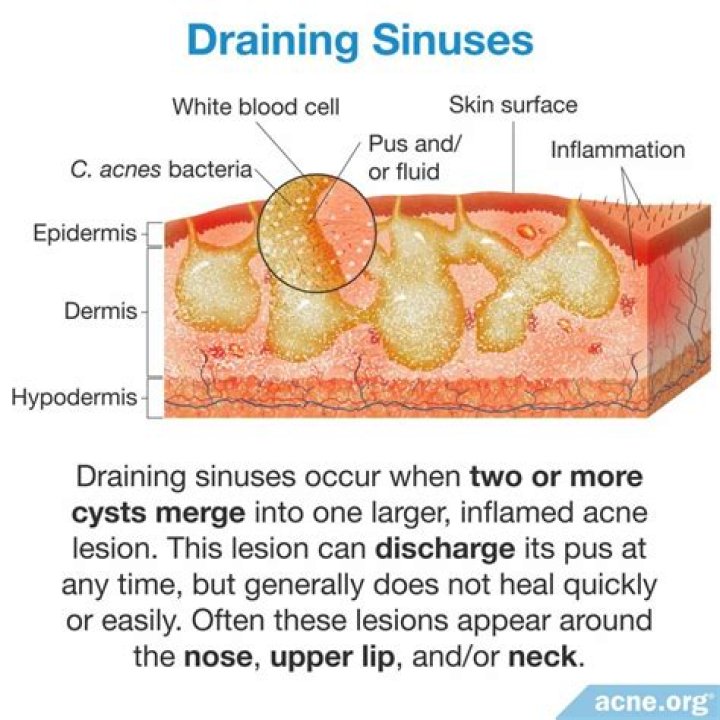 Could sinus drainage cause nausea?