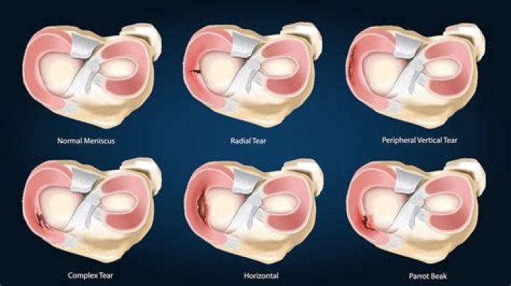 Could you walk with a torn meniscus?