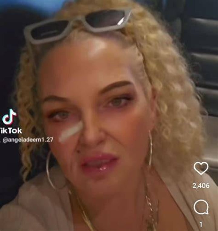 Did angela have skin removal surgery?