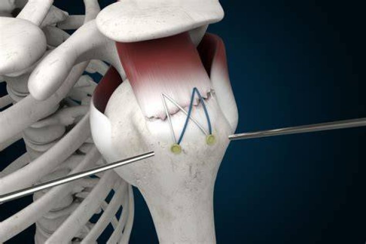 Did kobe have rotator cuff surgery?