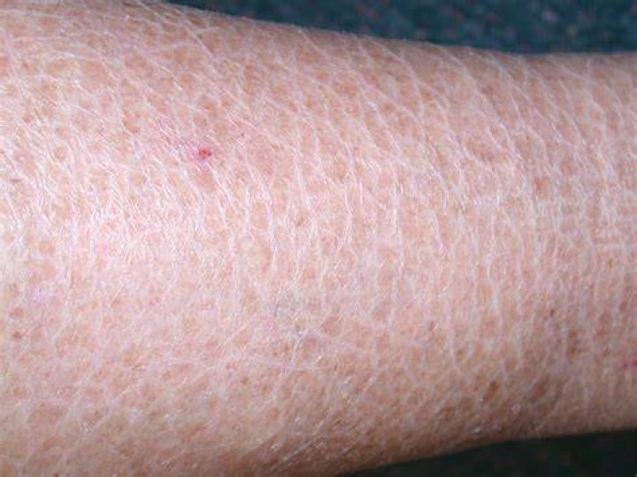 Do age spots get scaly?