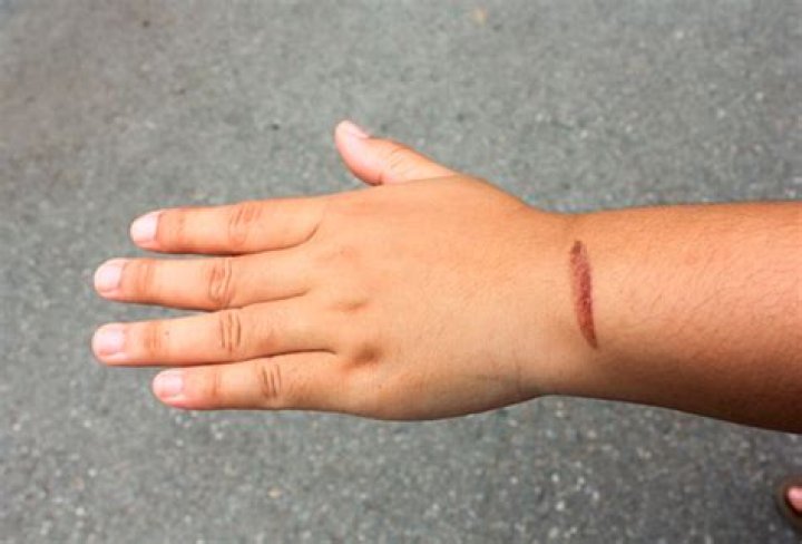 Do burn marks go away?