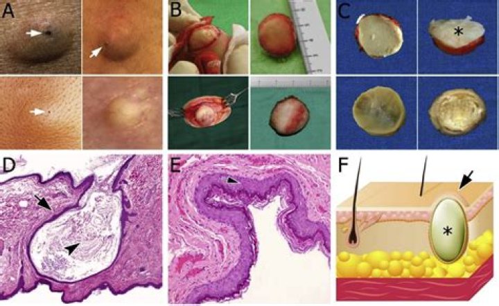 Do epidermal cysts hurt?