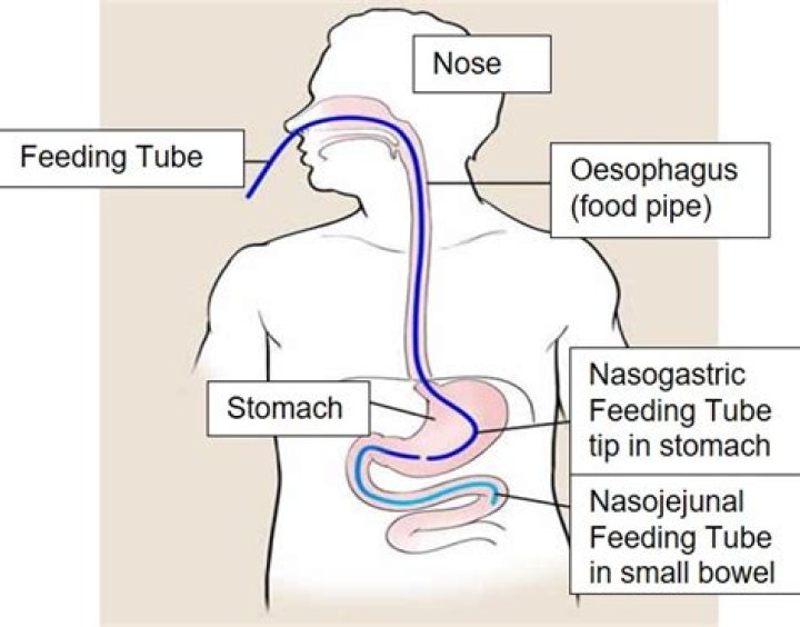Do feeding tubes work?