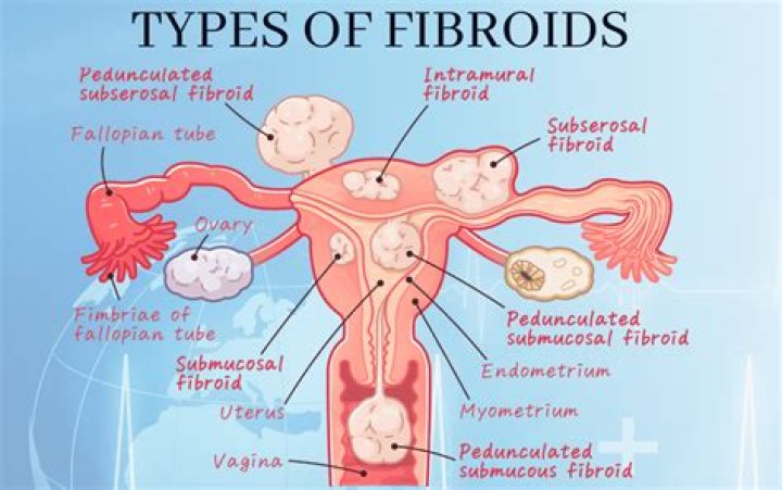 Do fibroids cause thickened endometrium?