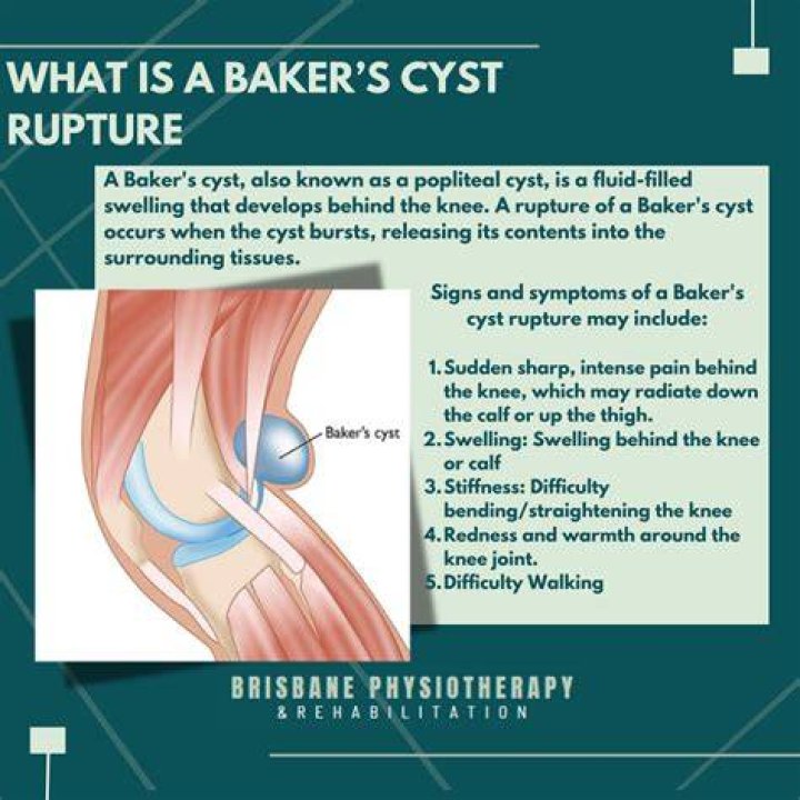 Do follicular cyst rupture?