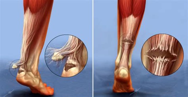 Do frayed tendons heal?