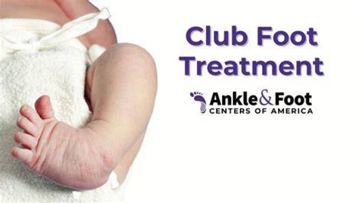 Do i have club foot?