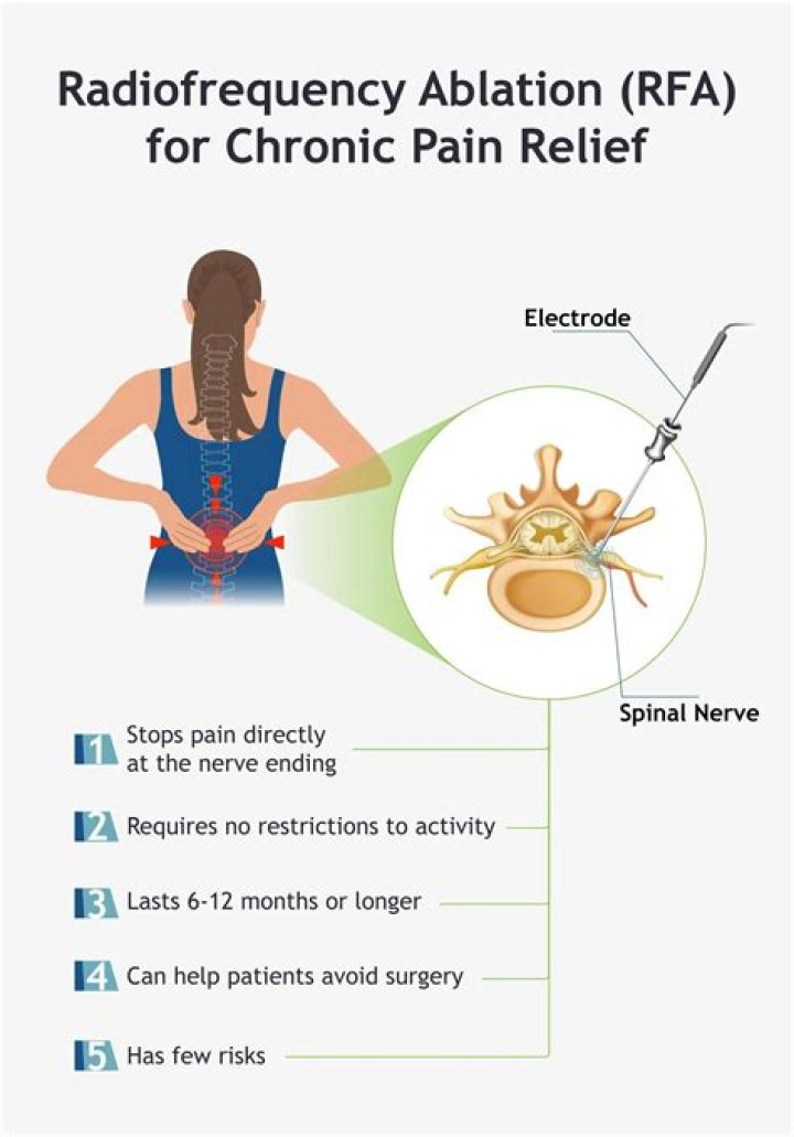 Do i need to fast for a radiofrequency ablation?