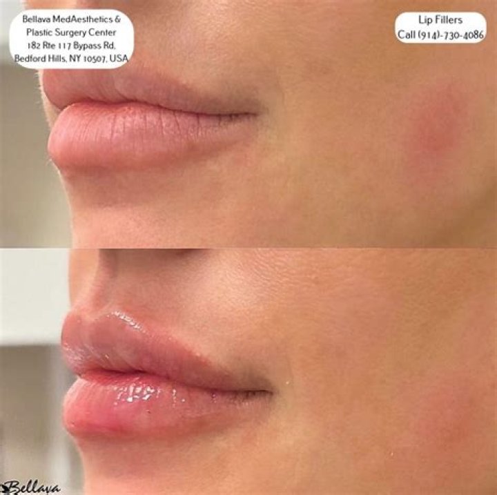 Do lip filler injections hurt?