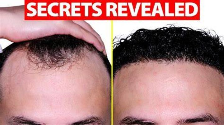 Do receding hairlines stop?