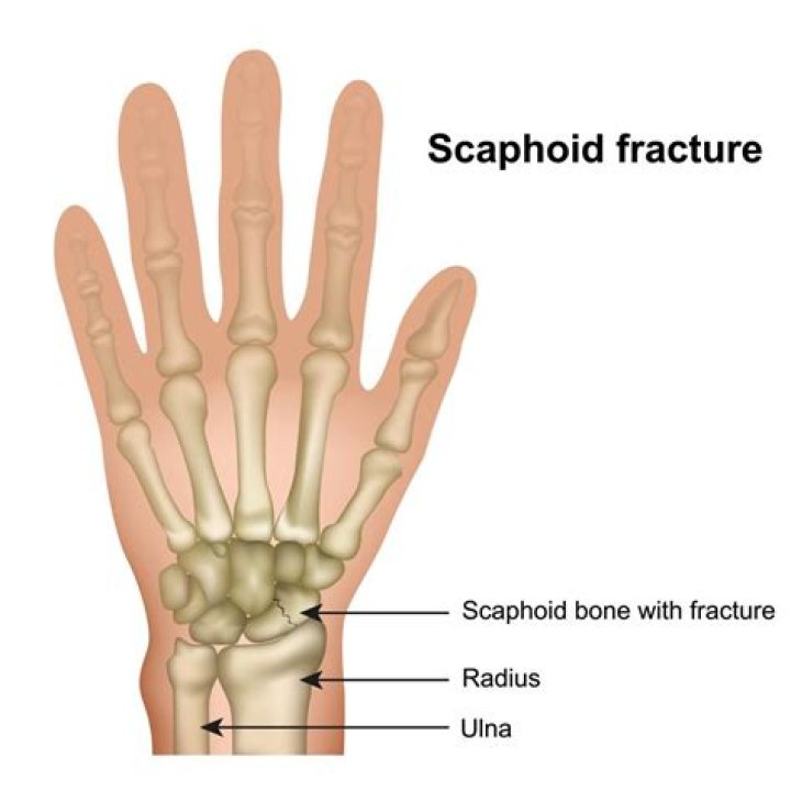 Do scaphoid fractures hurt?