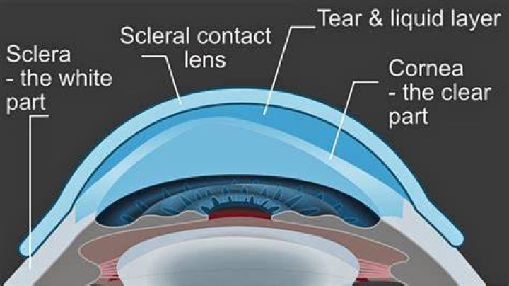 Do scleral lenses correct keratoconus?
