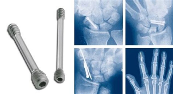 Do screws in bone hurt?