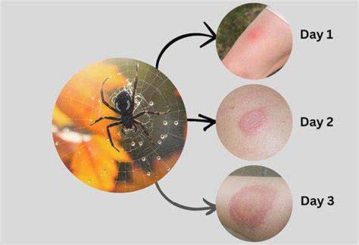 Do spider bites leave welts?
