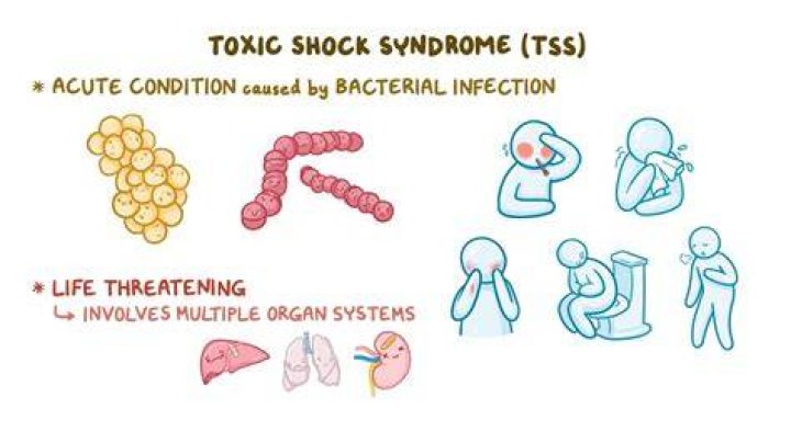 Do tampons cause toxic shock syndrome?