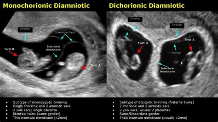 Do twins share amniotic sac?
