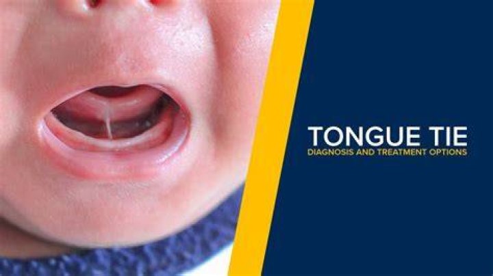 Do you have to fix a tongue tie?
